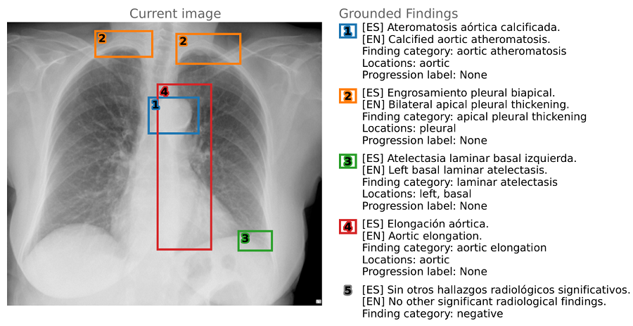 La UA impulsa un hito en IA médica con el lanzamiento del primer conjunto de datos bilingüe para radiología
